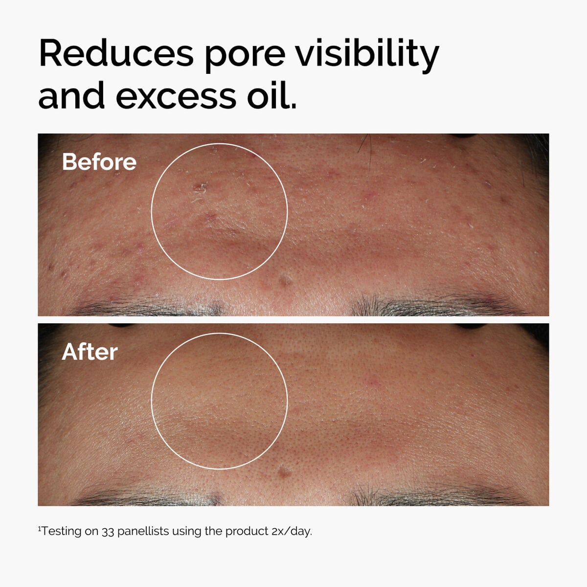 niacinamide-10-zinc-1-j6 ord-niacinamide-zinc-blemish-serum-before-after-pores.jpg