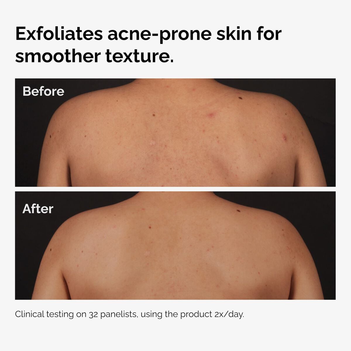 salicylic-acid-0-5-body-serum-n2 ord-salicylic-acid-body-serum-before-after-graphic-NA.jpg
