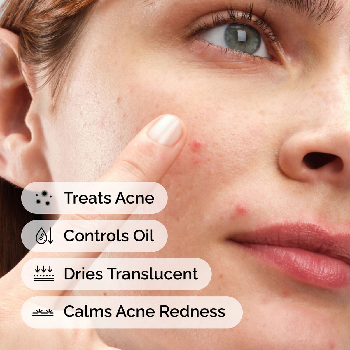 sulfur-10-powder-to-cream-concentrate-l7 ord-sulfur-10pct-powder-to-cream-concentrate-model-application-with-benefits-acne.jpg